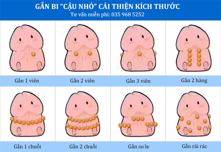 Cấy bi có đau không?